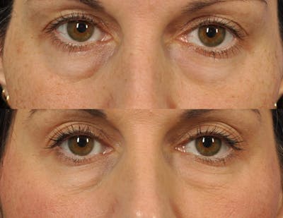 Radiofrequency Microneedling (Morpheus8) Before & After Gallery - Patient 181282 - Image 1
