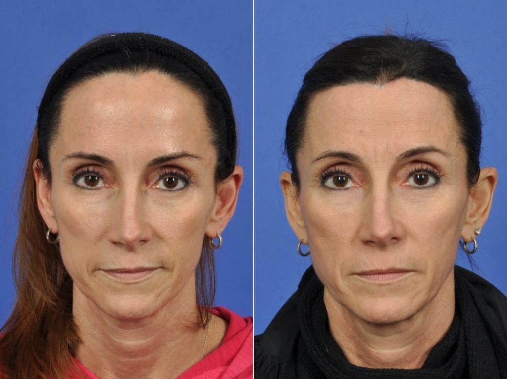 Hairline Lowering Before & After Gallery - Patient 200265 - Image 1