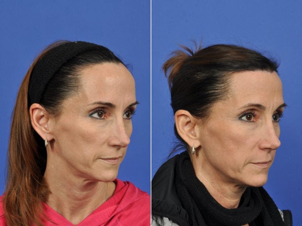 Hairline Lowering Before & After Gallery - Patient 200265 - Image 2
