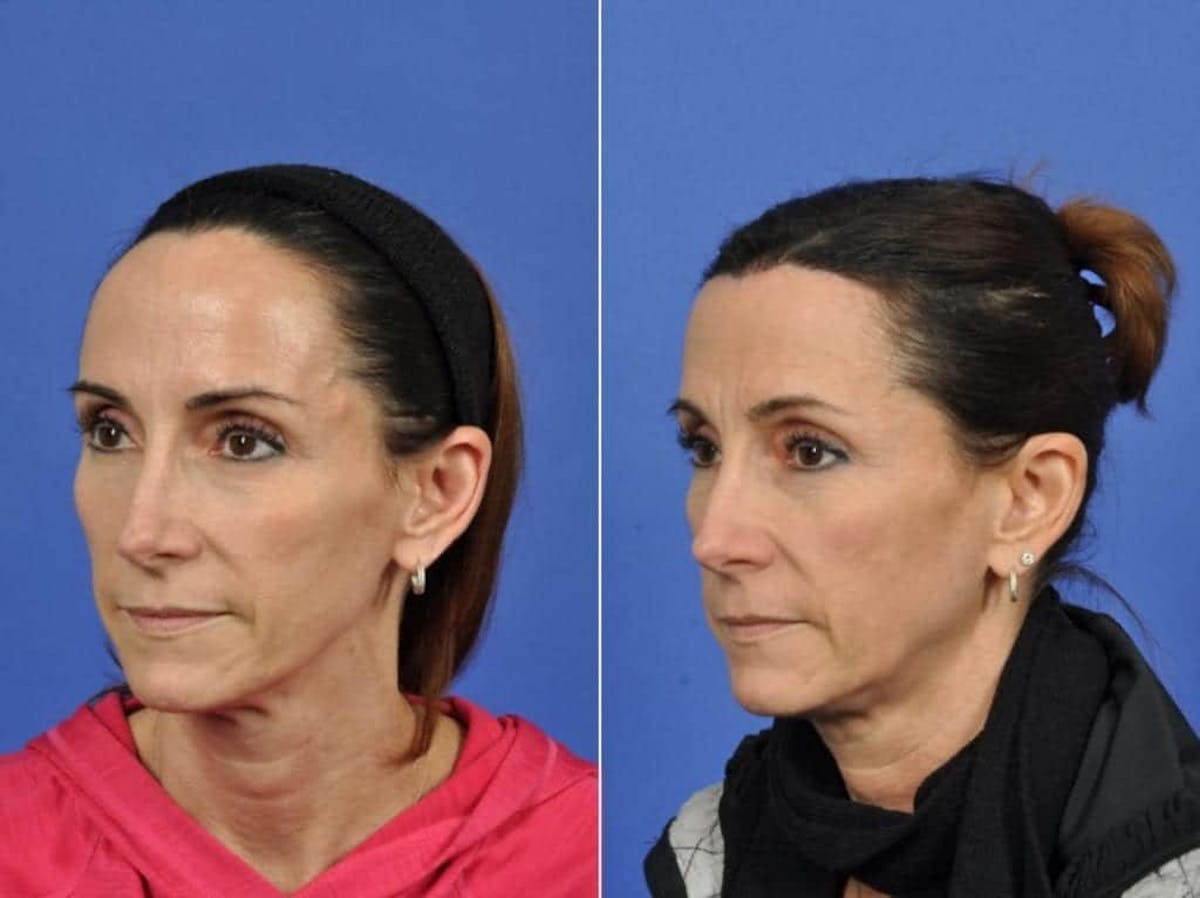 Hairline Lowering Before & After Gallery - Patient 200265 - Image 3