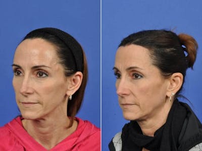 Hairline Lowering Before & After Gallery - Patient 200265 - Image 3