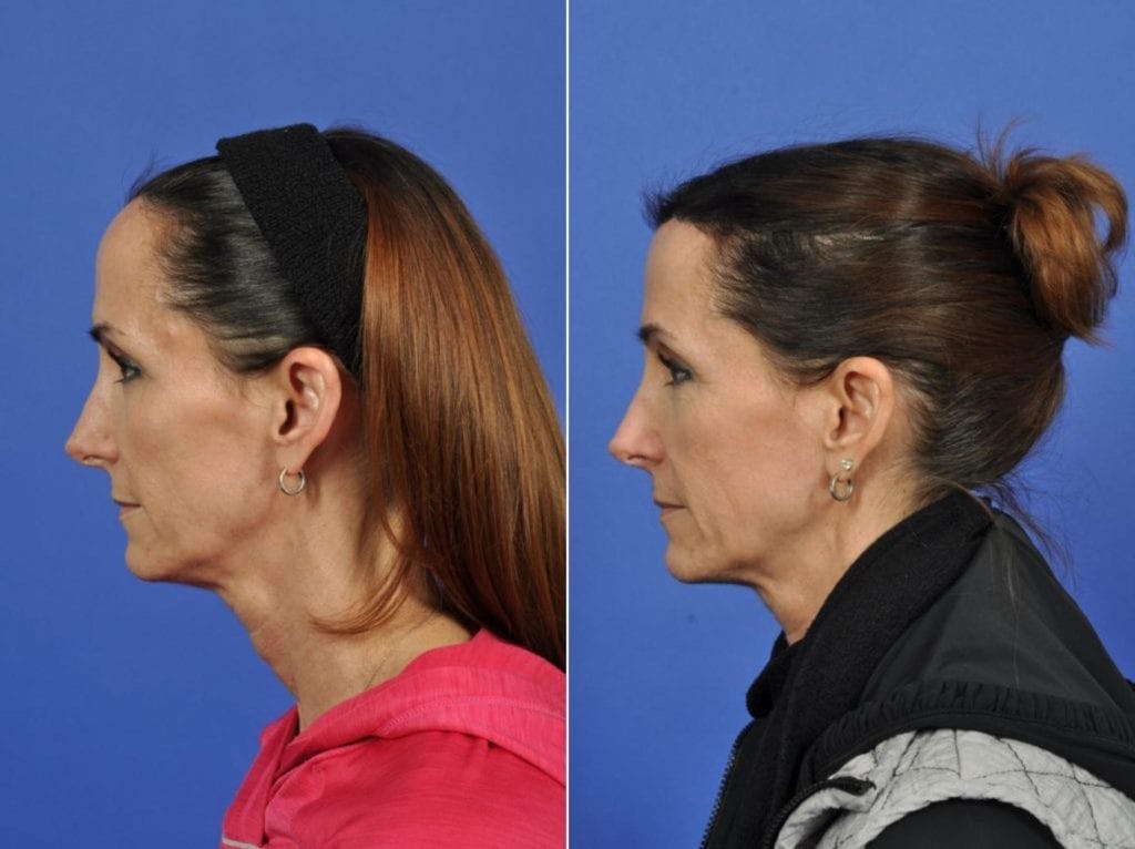 Hairline Lowering Before & After Gallery - Patient 200265 - Image 4