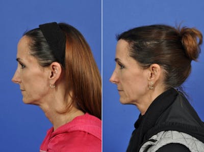 Hairline Lowering Before & After Gallery - Patient 200265 - Image 4