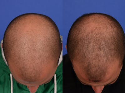 PRP for Hair Loss Before & After Gallery - Patient 339192 - Image 1