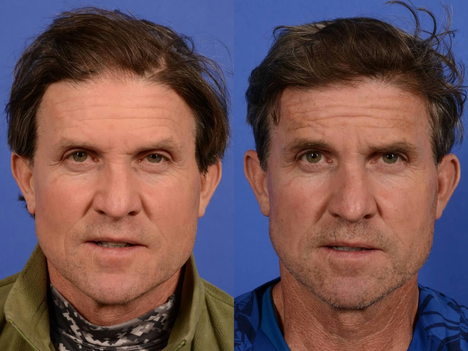 PRP for Hair Loss Before & After Gallery - Patient 980238 - Image 1