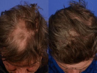 PRP for Hair Loss Before & After Gallery - Patient 980238 - Image 2