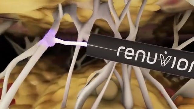 Renuvion video screenshot