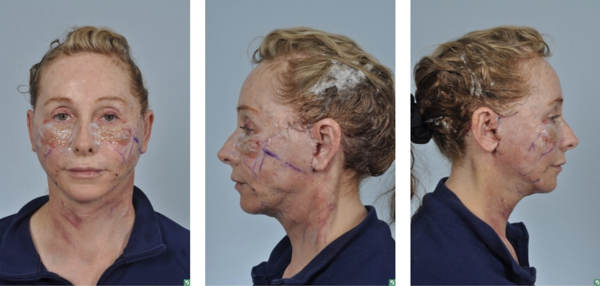 patient after facelift surgery