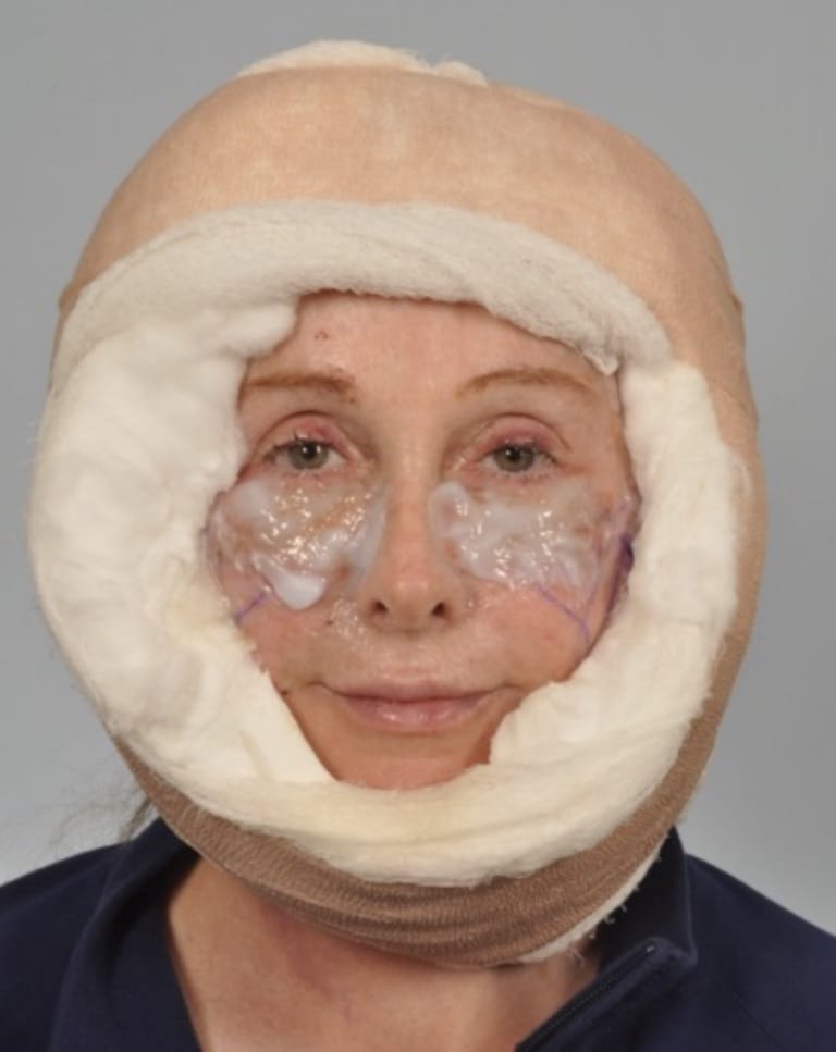 patient after facelift surgery