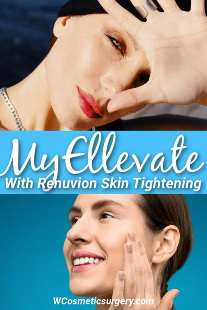 Facelifts are the gold standard but what about alternatives like a MyEllevate procedure? This might be the better option for some.