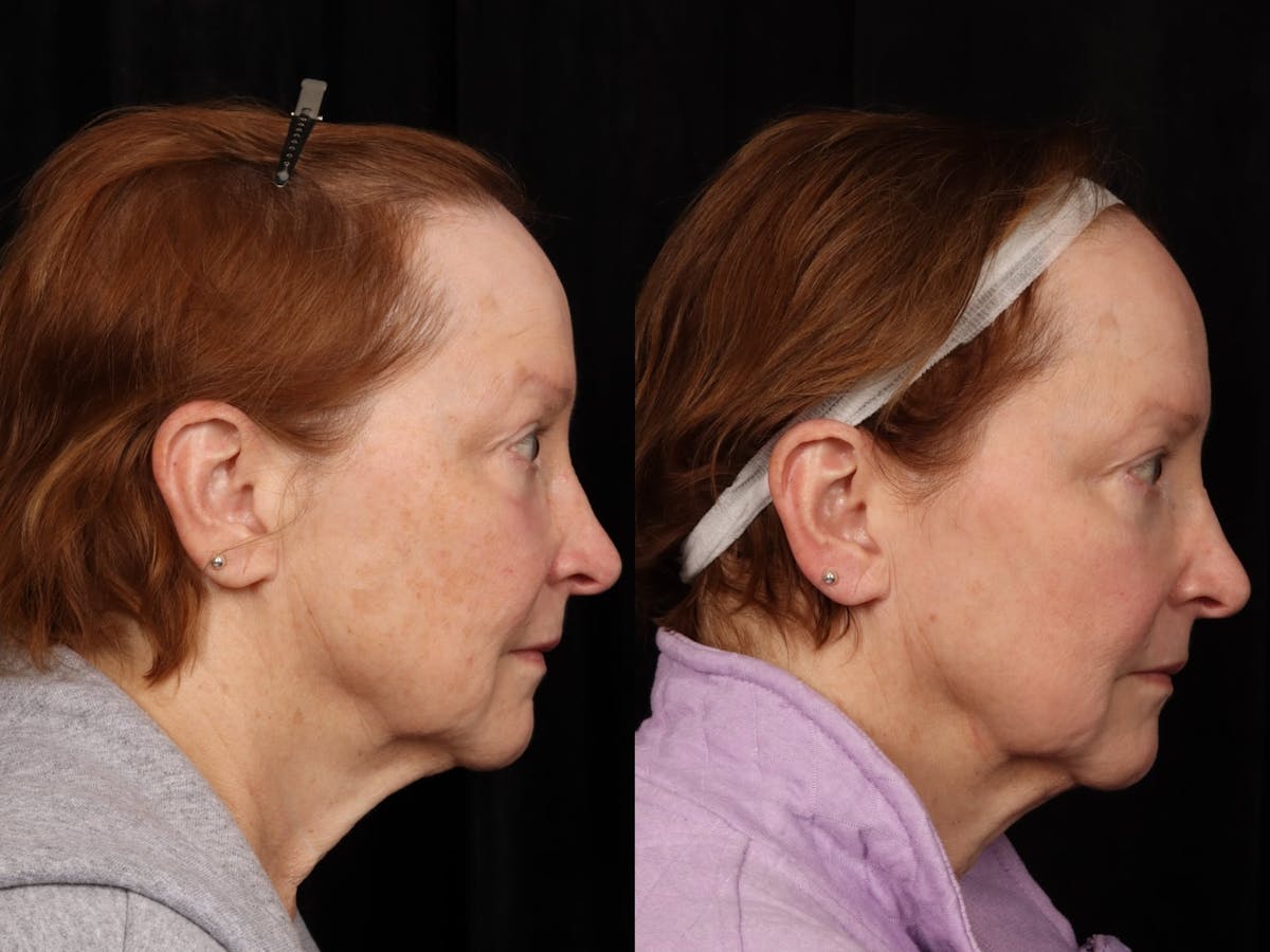 UltraClear™ Laser Before & After Gallery - Patient 165015 - Image 3