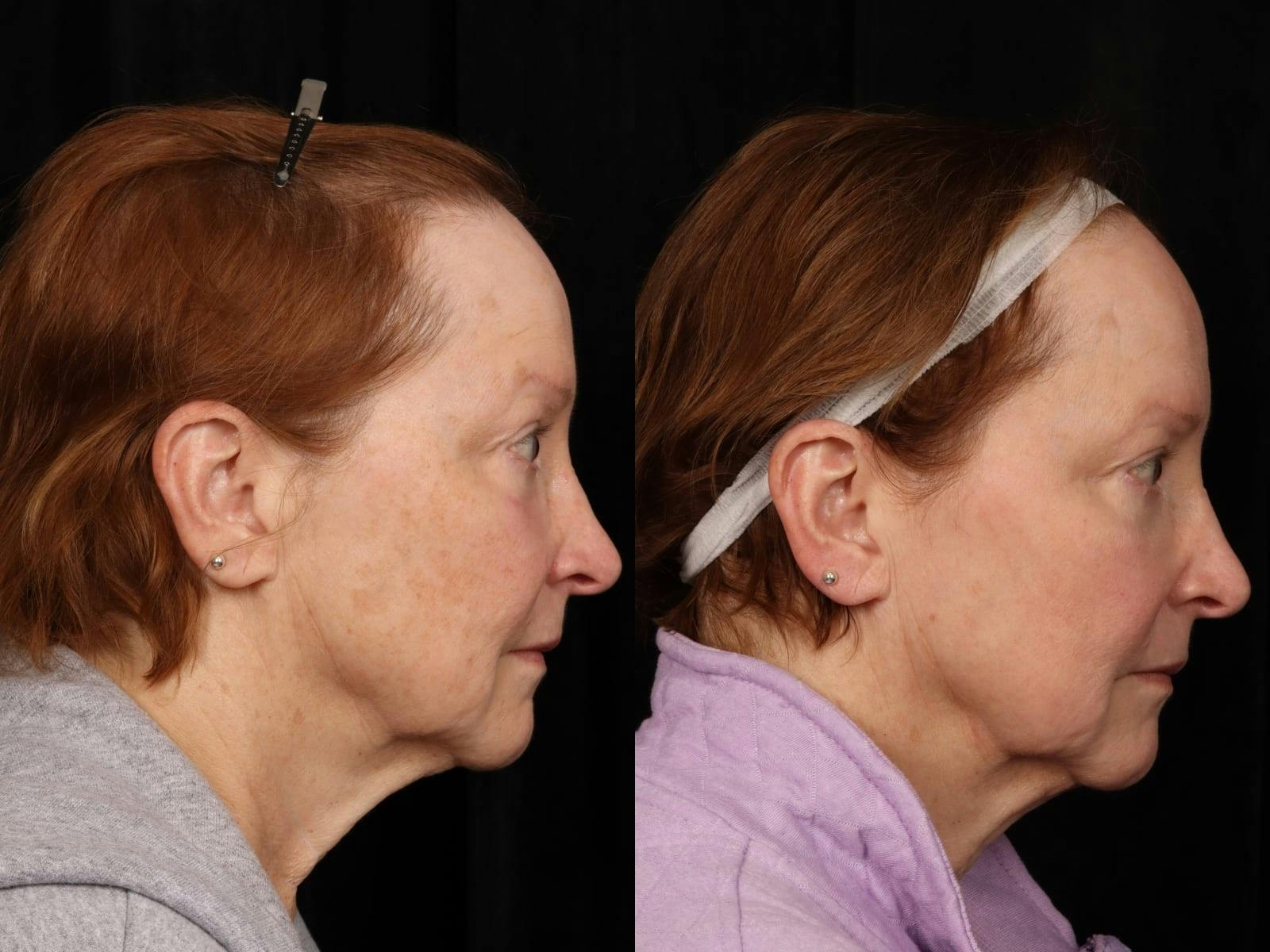 UltraClear™ Laser Before & After Gallery - Patient 165015 - Image 3