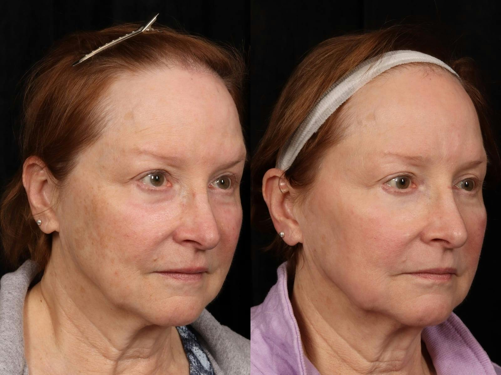 UltraClear™ Laser Before & After Gallery - Patient 165015 - Image 2
