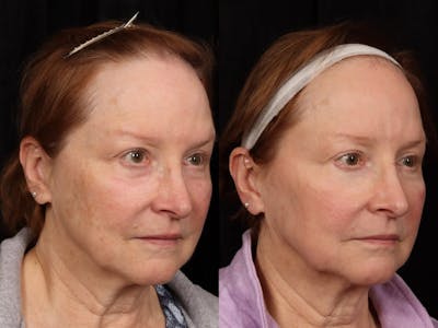 UltraClear™ Laser Before & After Gallery - Patient 165015 - Image 2