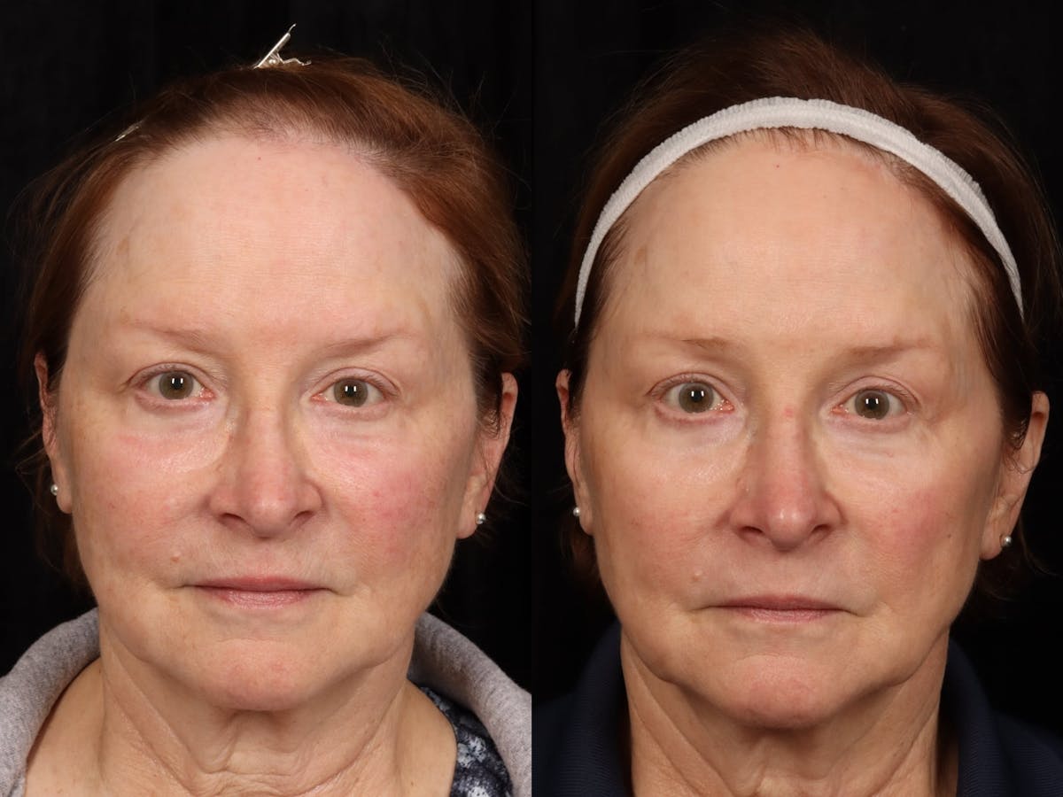 UltraClear™ Laser Before & After Gallery - Patient 165015 - Image 1