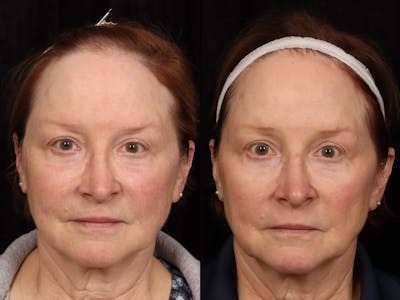 UltraClear™ Laser Before & After Gallery - Patient 165015 - Image 1