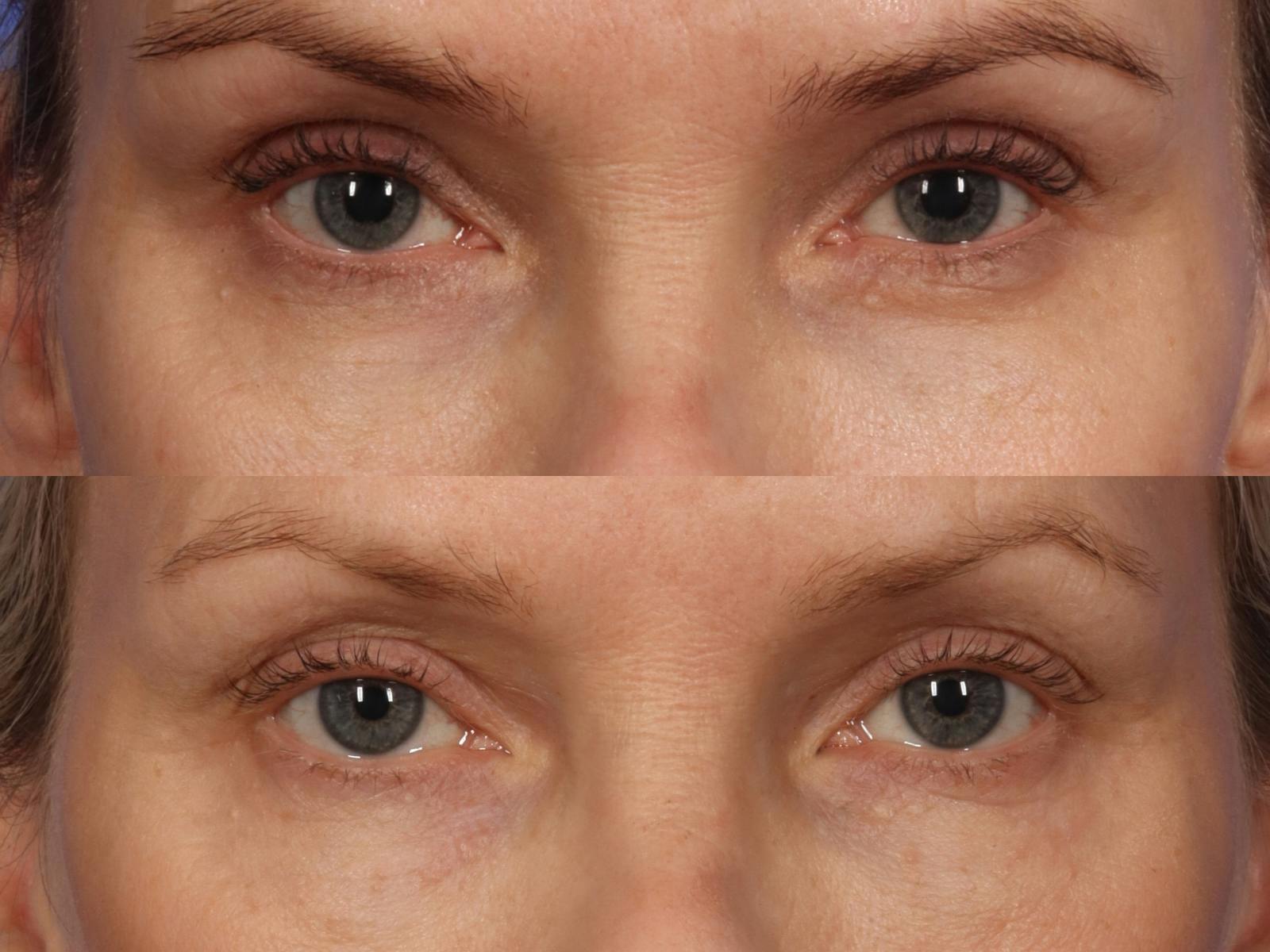 UltraClear™ Laser Before & After Gallery - Patient 352023 - Image 2