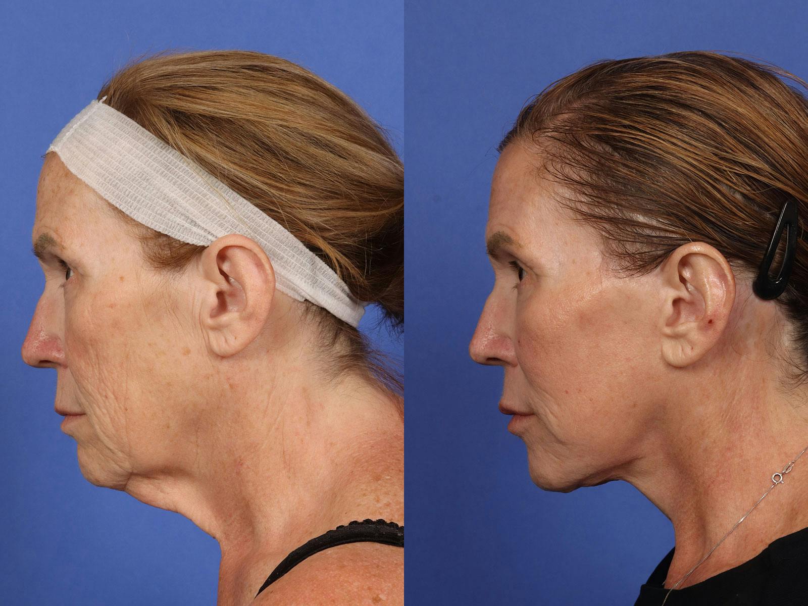 Neck Lift Before & After Gallery - Patient 199796 - Image 2