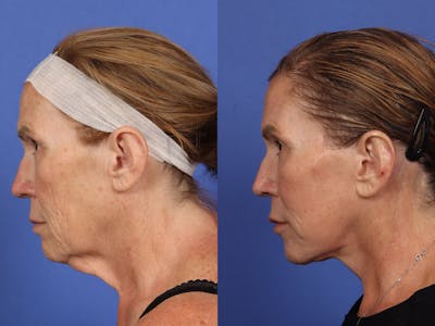 Neck Lift Before & After Gallery - Patient 199796 - Image 2