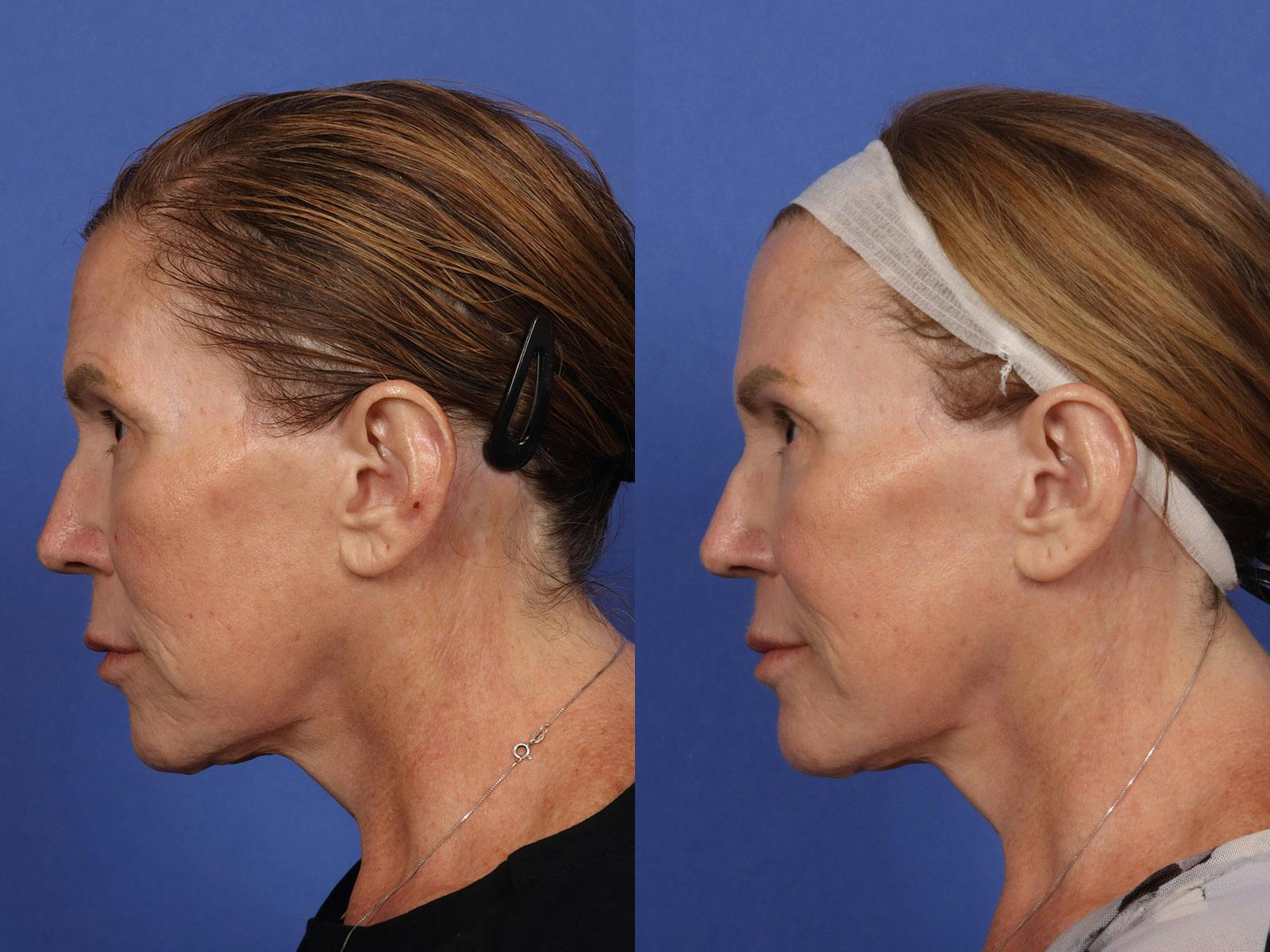 Neck Lift Before & After Gallery - Patient 199796 - Image 4