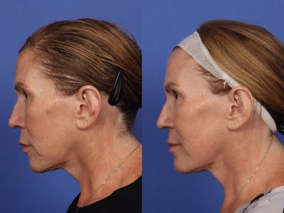 Neck Lift Before & After Gallery - Patient 199796 - Image 4