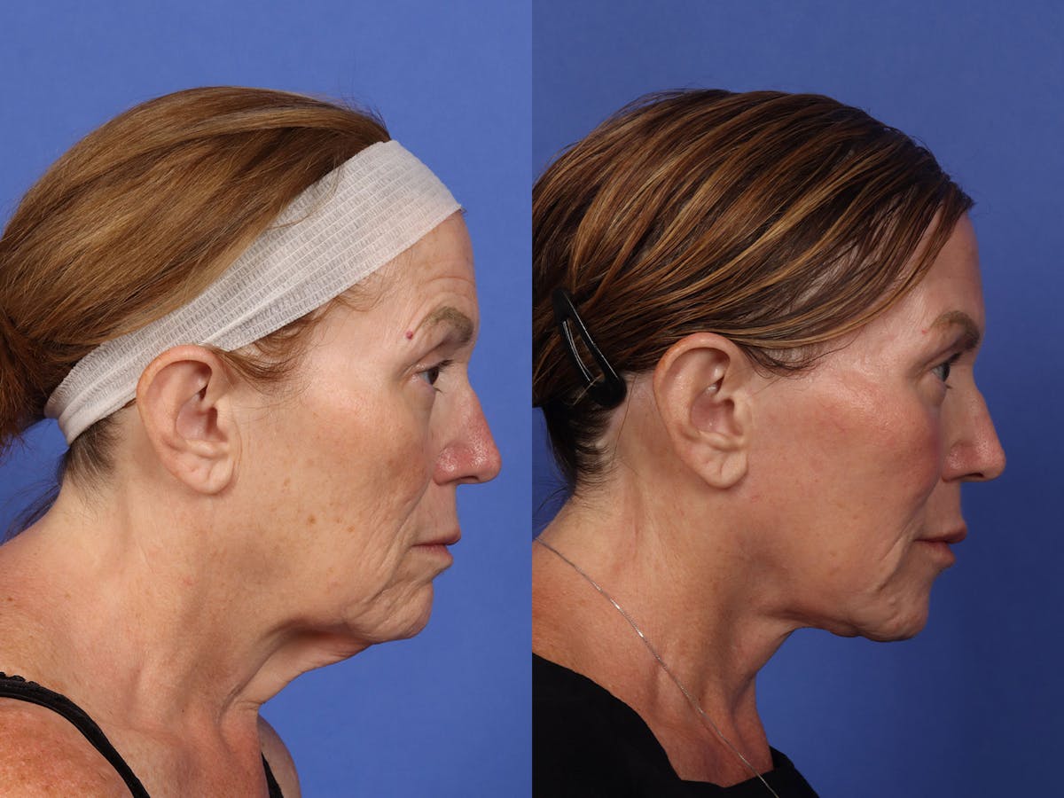 Neck Lift Before & After Gallery - Patient 199796 - Image 1