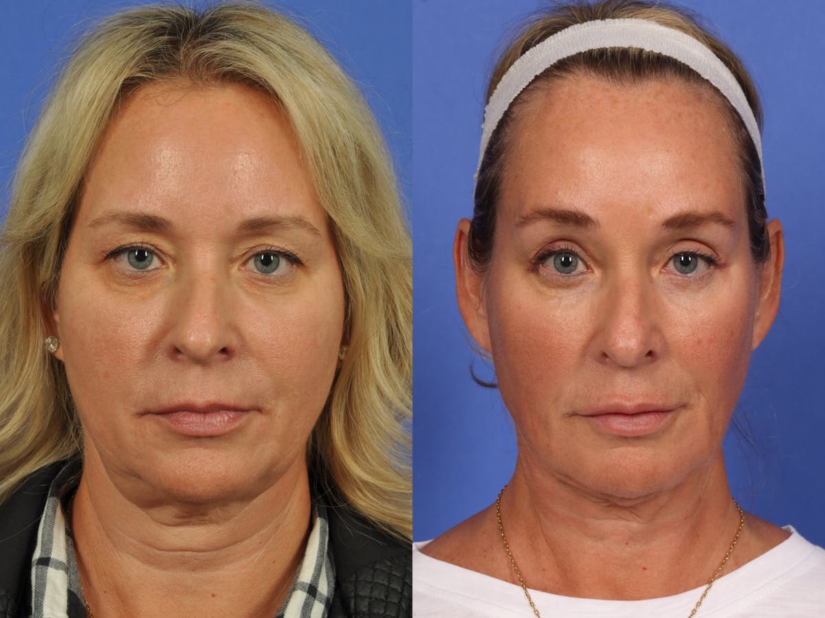 Brow Lift Before & After Gallery - Patient 792533 - Image 1