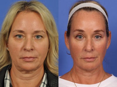 WNatural Micromidfacelift™ Before & After Gallery - Patient 361035 - Image 1