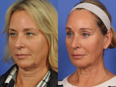 Mid Facelift Before & After Gallery - Patient 362985 - Image 2