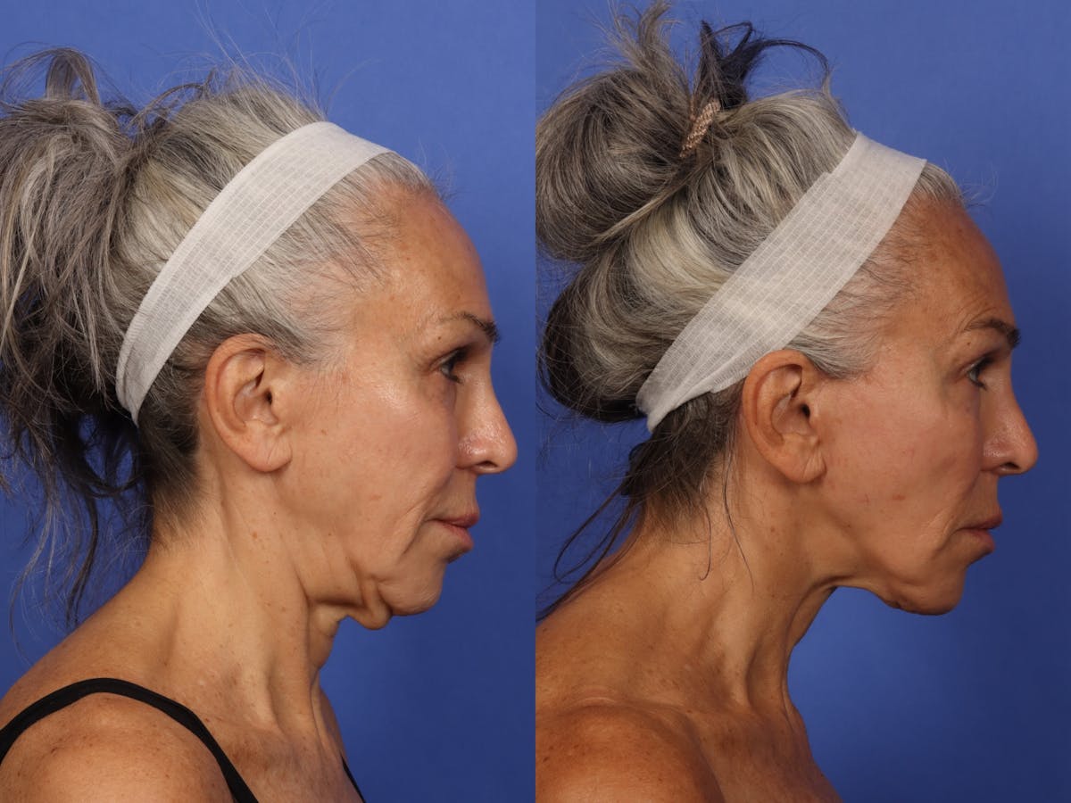 Fillers Before & After Gallery - Patient 374940 - Image 2