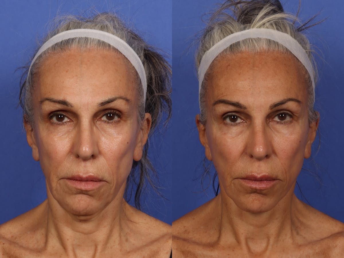 Liposculpture Before & After Gallery - Patient 726358 - Image 1