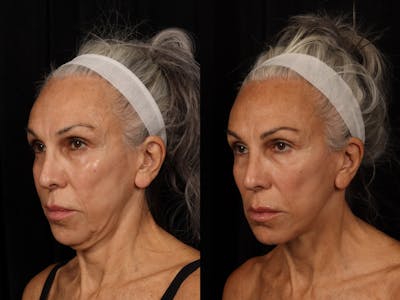 Liposculpture Before & After Gallery - Patient 726358 - Image 5