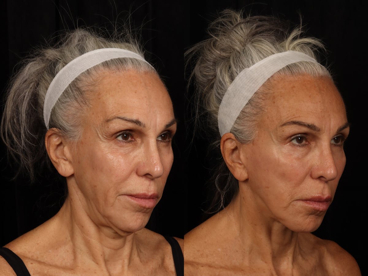 Liposculpture Before & After Gallery - Patient 726358 - Image 4