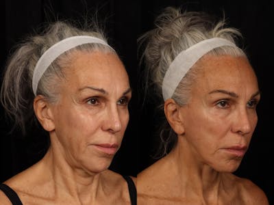 Chin Implant Before & After Gallery - Patient 882928 - Image 4