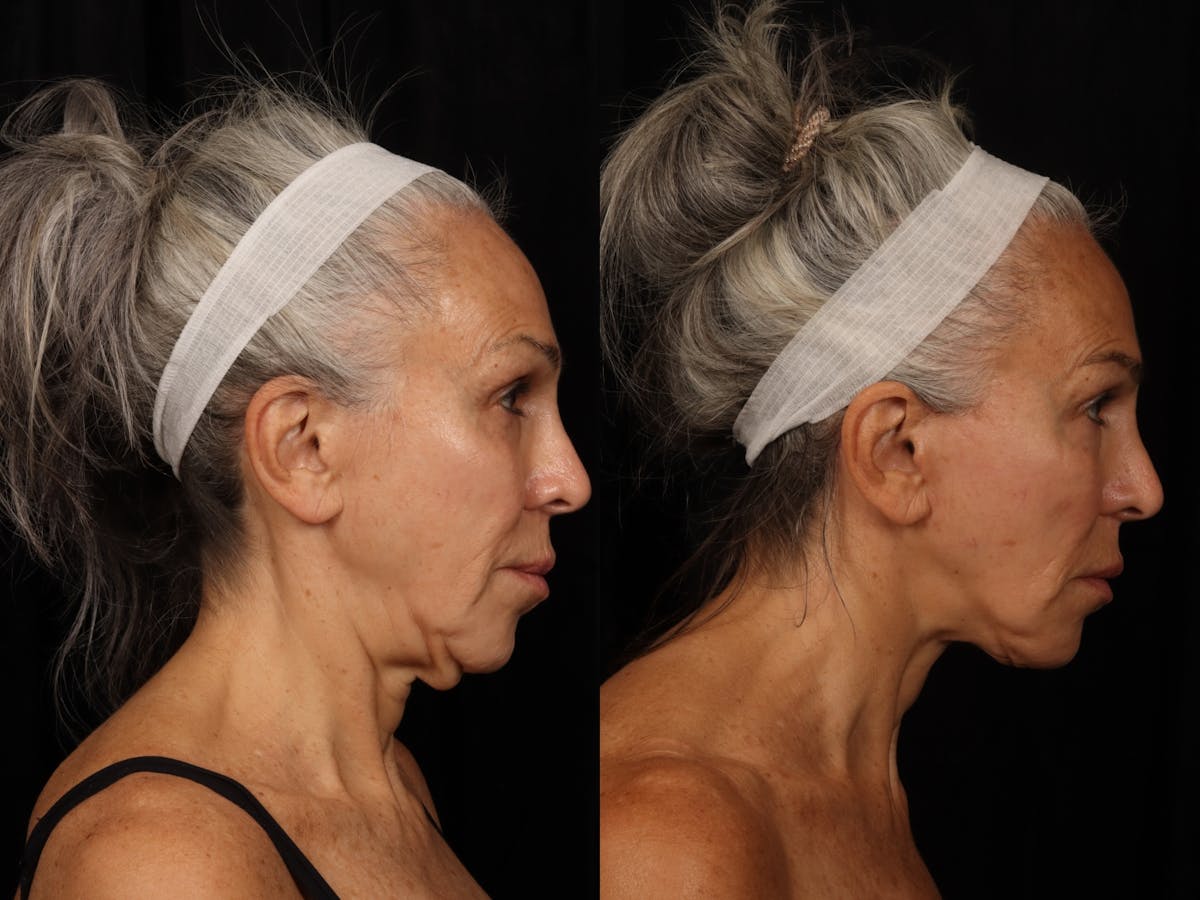 Liposculpture Before & After Gallery - Patient 726358 - Image 3