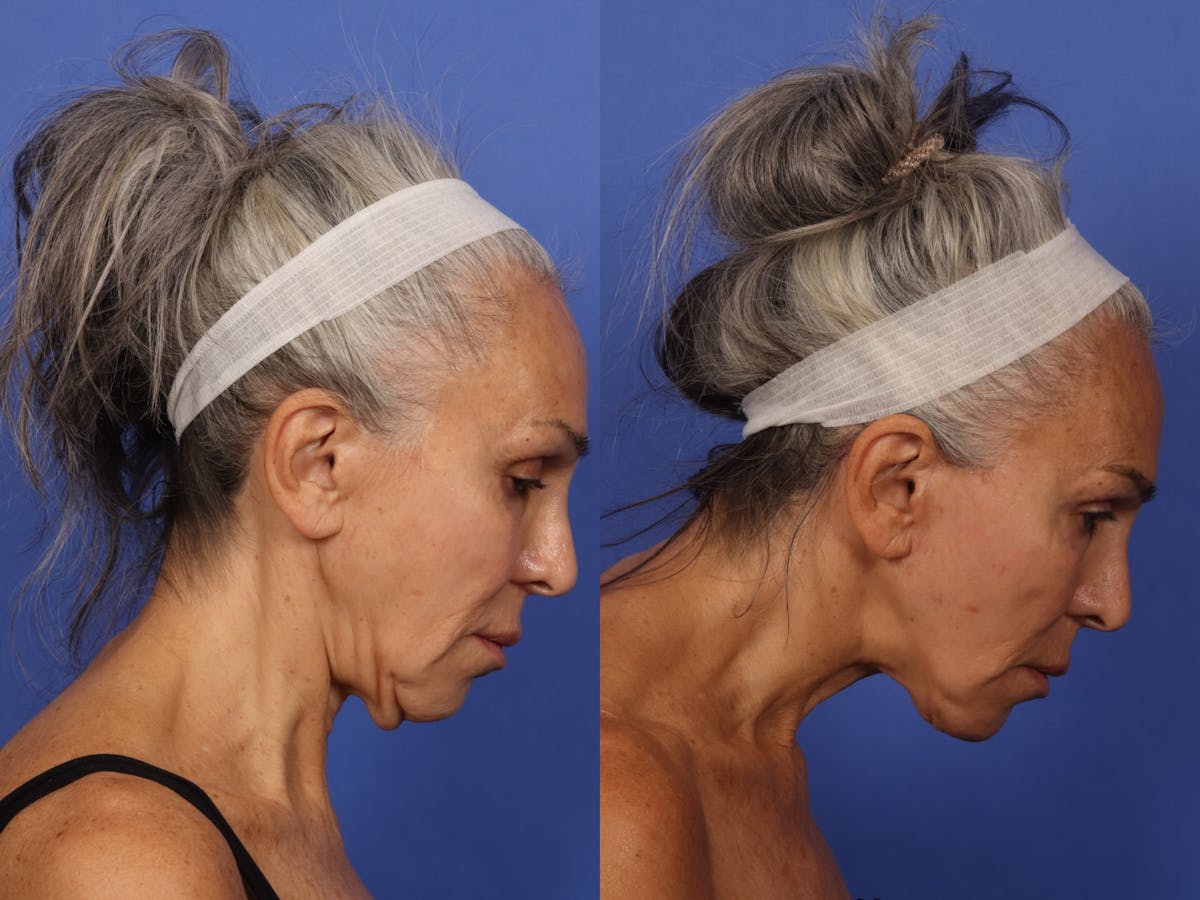 Liposculpture Before & After Gallery - Patient 726358 - Image 2
