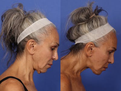 Chin Implant Before & After Gallery - Patient 882928 - Image 2