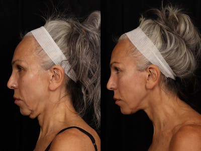Liposculpture Before & After Gallery - Patient 726358 - Image 6