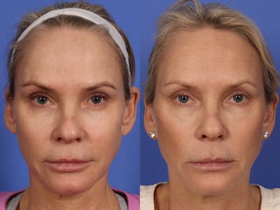 UltraClear™ Laser Before & After Gallery - Patient 352023 - Image 1