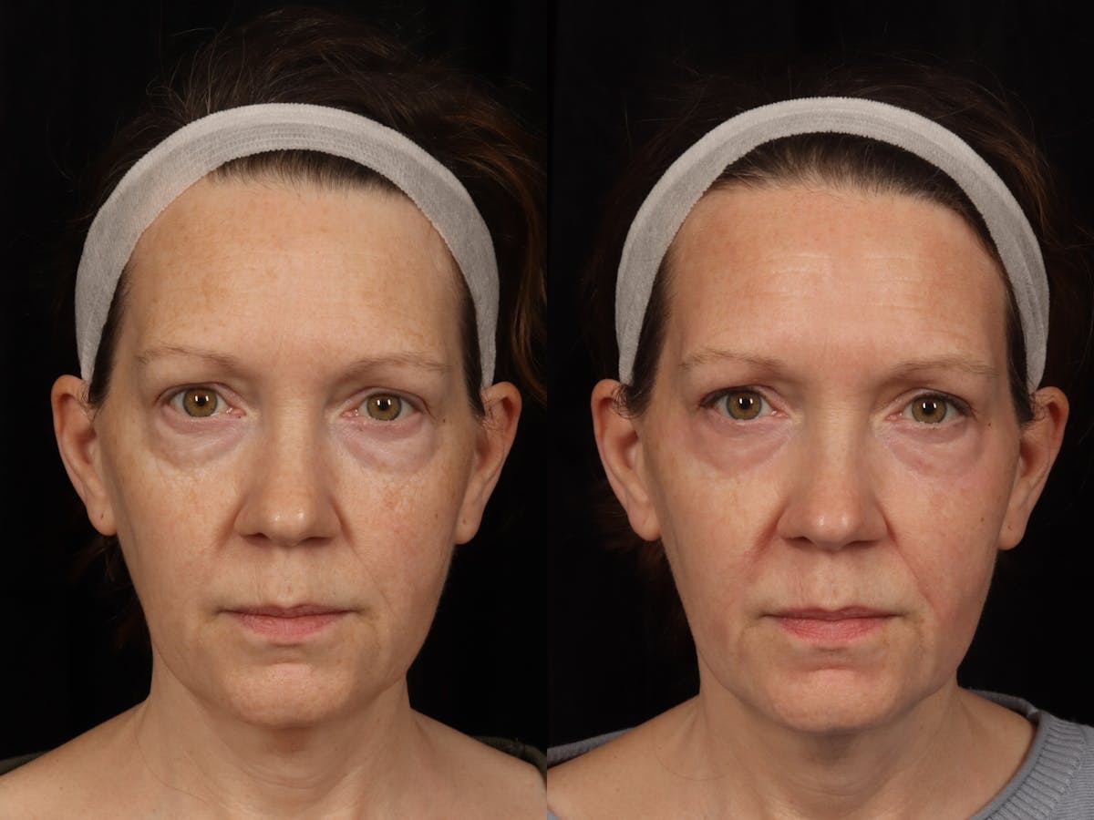 UltraClear™ Laser Before & After Gallery - Patient 199769 - Image 1