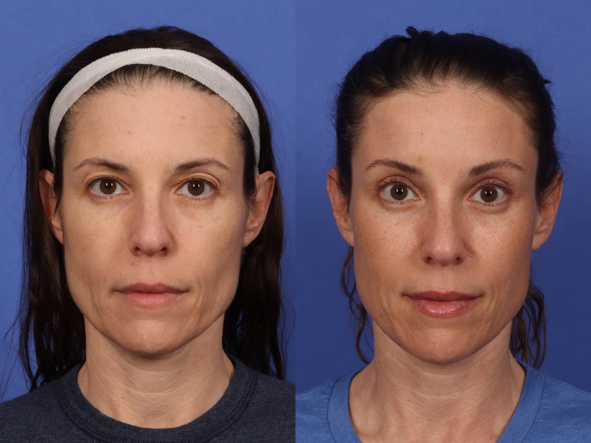 Brow Lift Before & After Gallery - Patient 174988 - Image 2