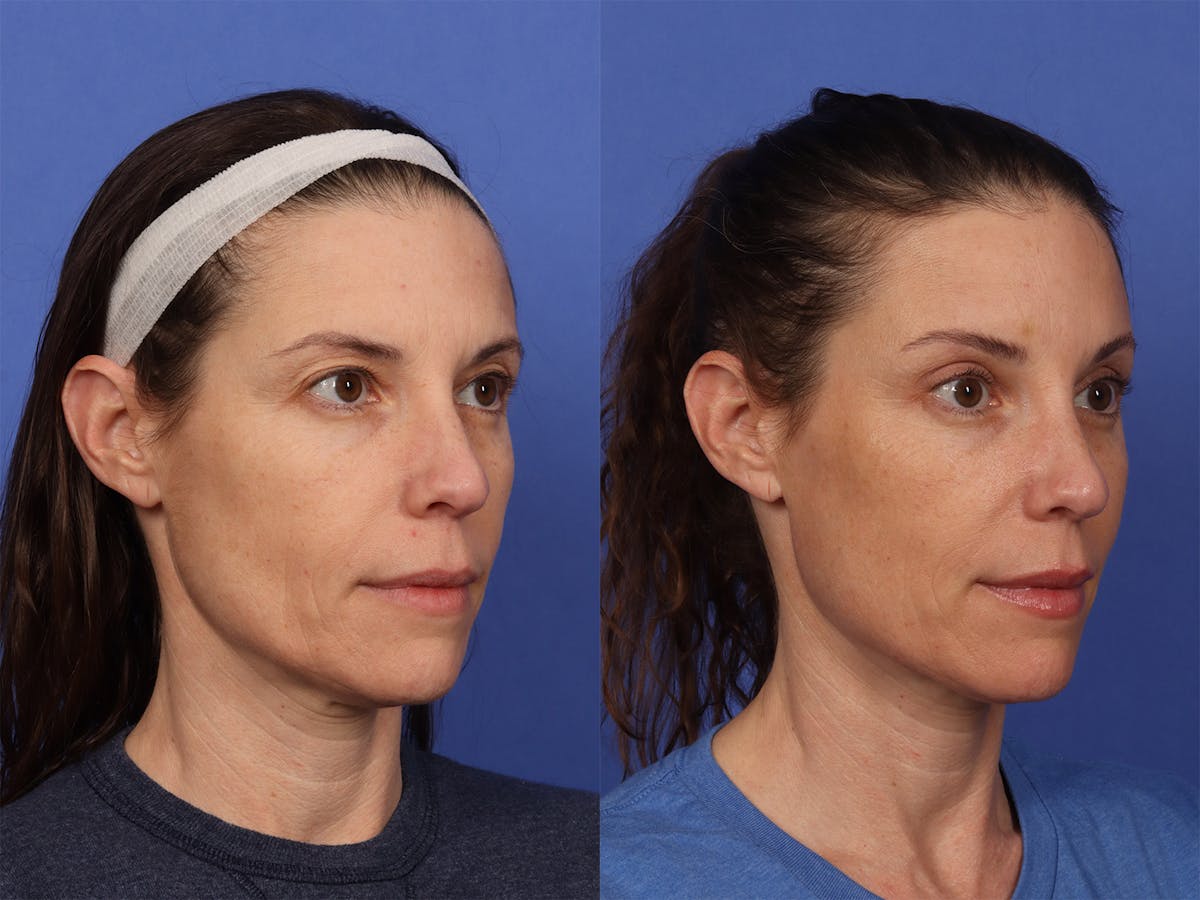 Brow Lift Before & After Gallery - Patient 174988 - Image 3