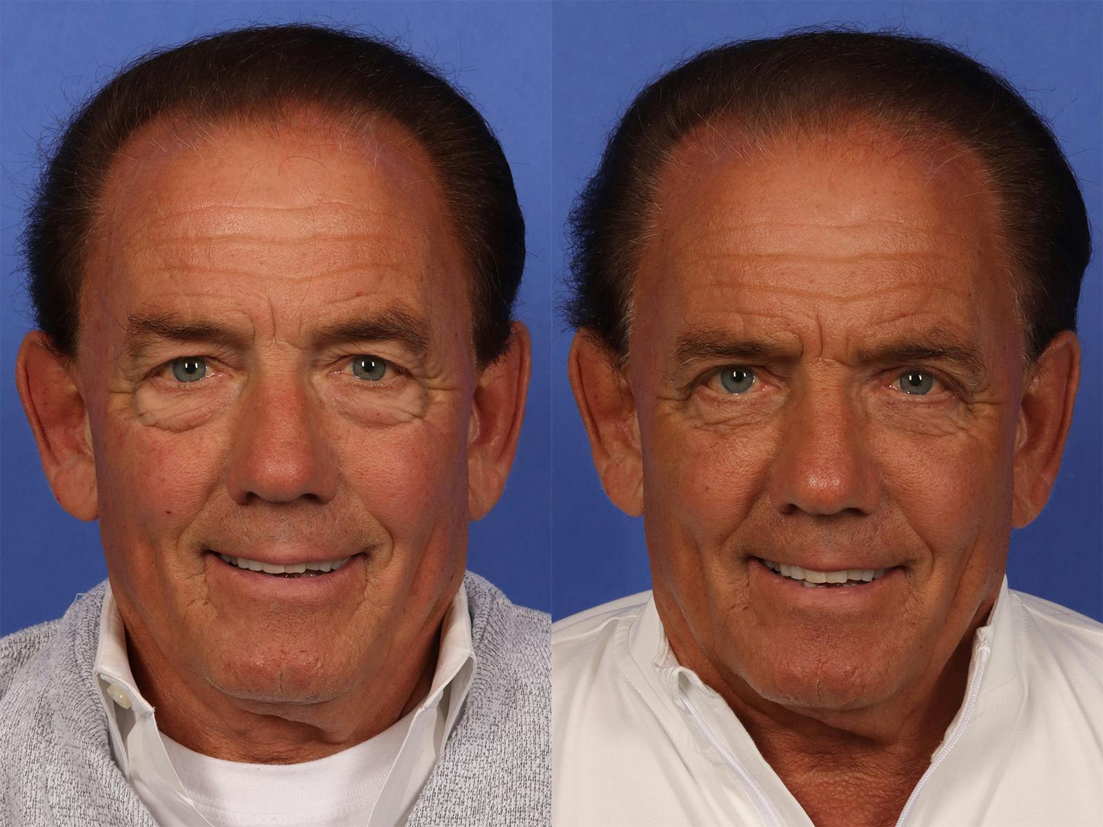 Injectables Before & After Gallery - Patient 233117 - Image 1