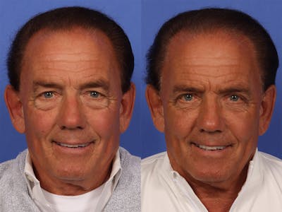 Liposculpture Before & After Gallery - Patient 237461 - Image 1