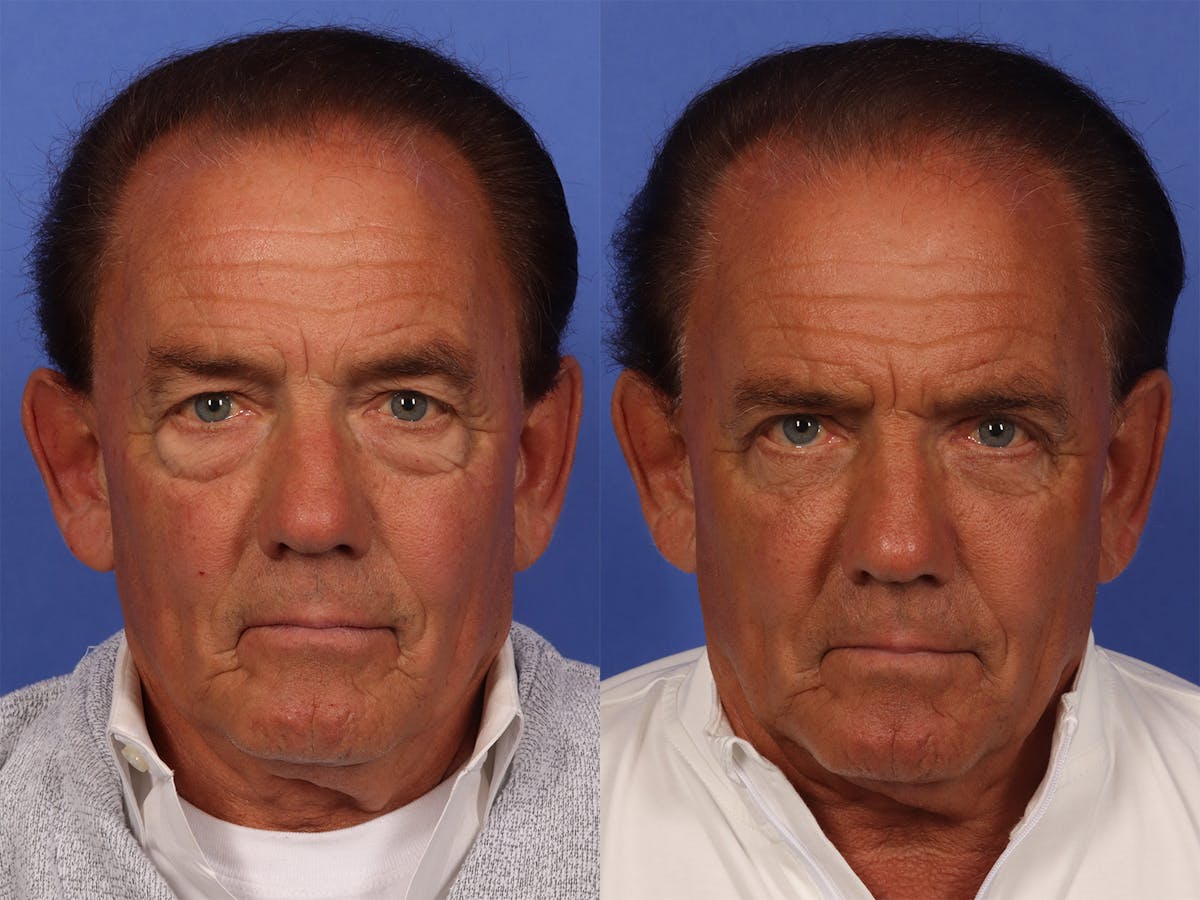 Liposculpture Before & After Gallery - Patient 237461 - Image 2