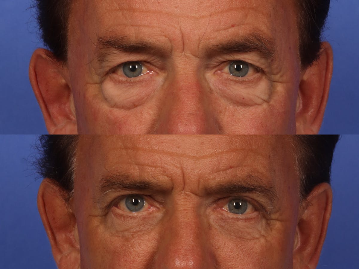 Liposculpture Before & After Gallery - Patient 237461 - Image 3