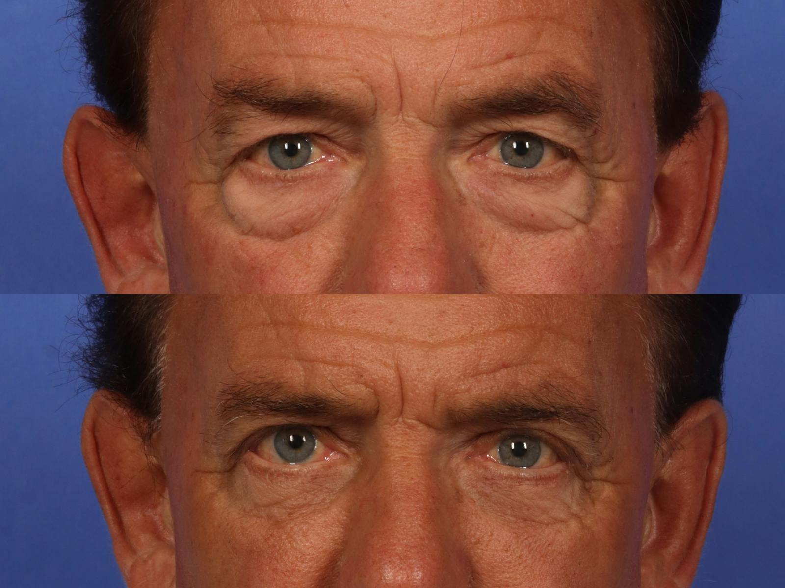 Injectables Before & After Gallery - Patient 233117 - Image 3
