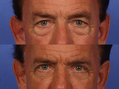 Injectables Before & After Gallery - Patient 233117 - Image 3