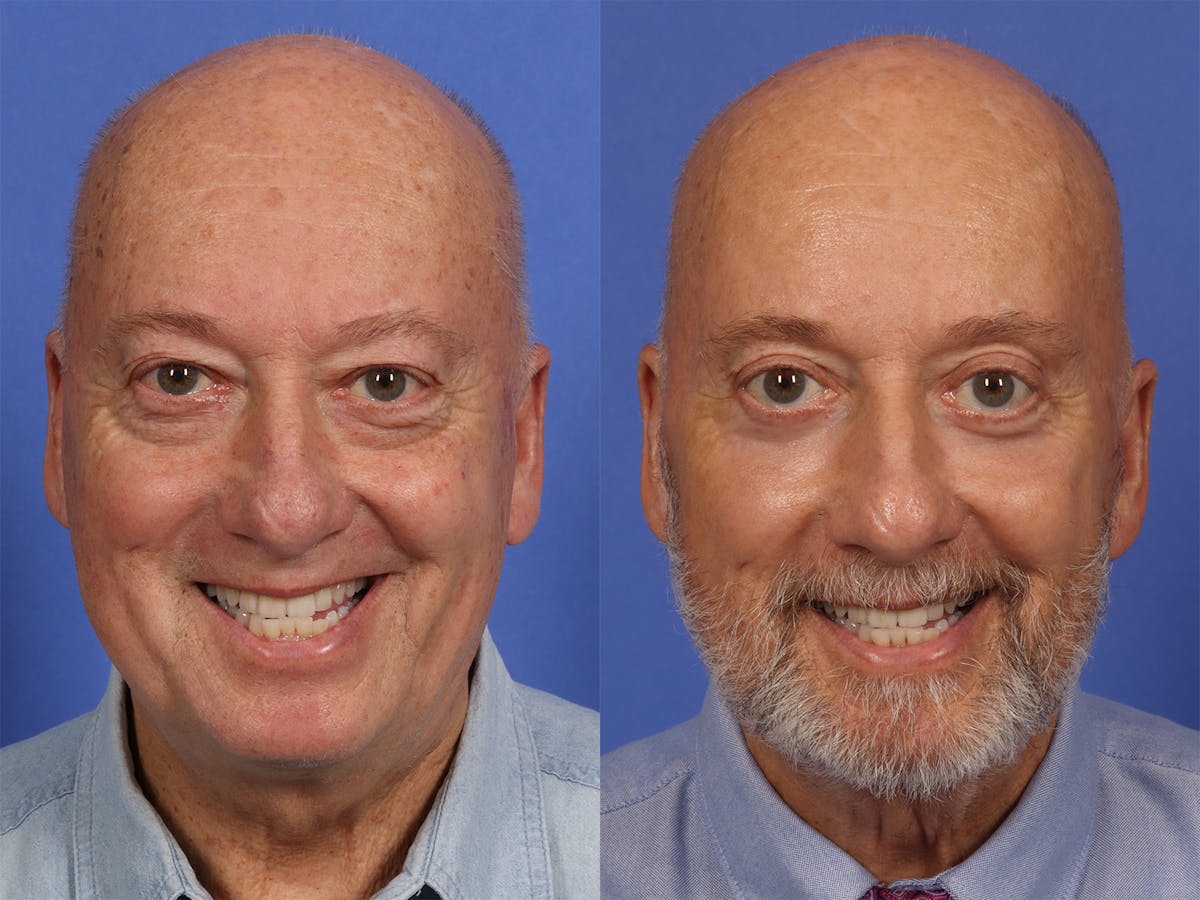 Liposculpture Before & After Gallery - Patient 254724 - Image 2