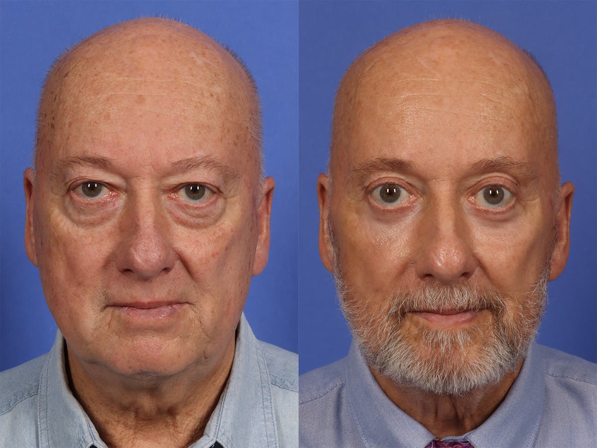 Liposculpture Before & After Gallery - Patient 254724 - Image 1